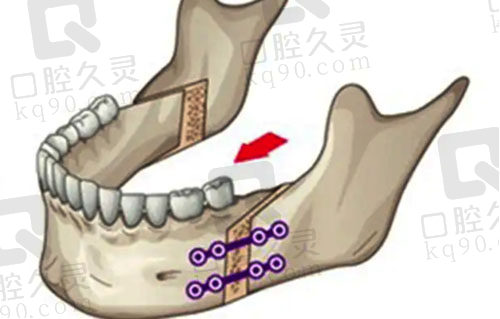 骨性牙突可以进行正颌手术