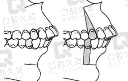 牙性前突和骨性前突区别图