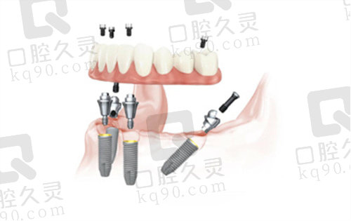 周建锋医生在all-on-4种植方面的技术优势3