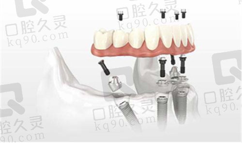 周建锋医生在all-on-4种植方面的技术优势4