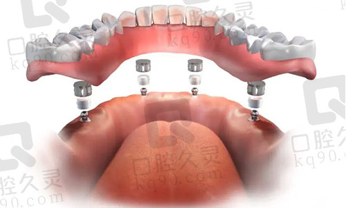 半口半固定种植牙