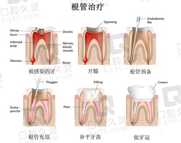 根管治疗