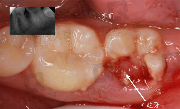 根管治疗前