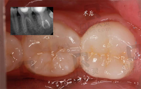 内蒙古欧贝口腔术后