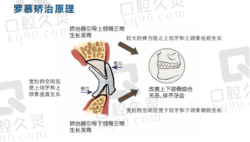 罗慕矫治器原理