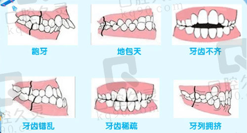 罗慕矫治器适应症