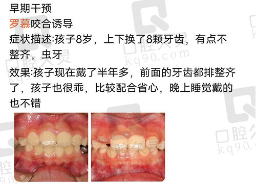 罗慕矫治器使用评价