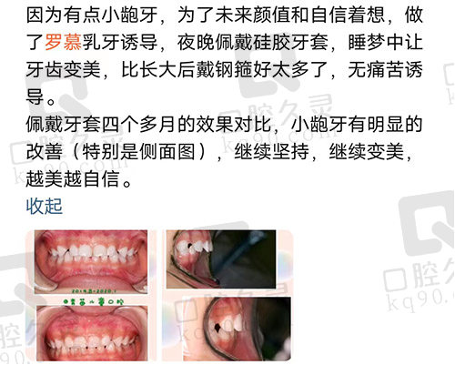 罗慕矫治器使用评价