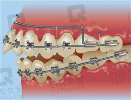 郑台镛医生在牙齿矫正方面的技术优势2