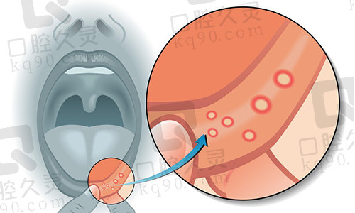 口腔溃疡