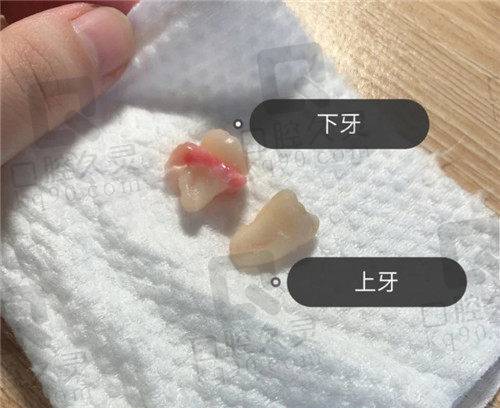 郑州植得口腔拔除的上下两颗智齿