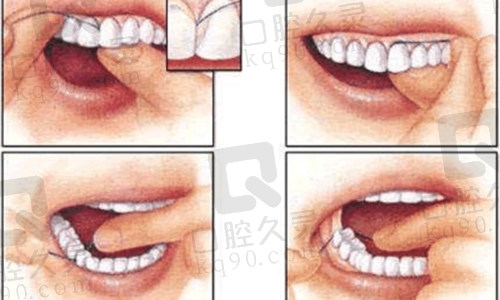 牙齿发白钙化