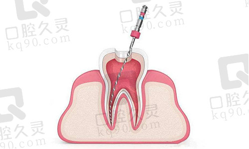 根管治疗扩张根管