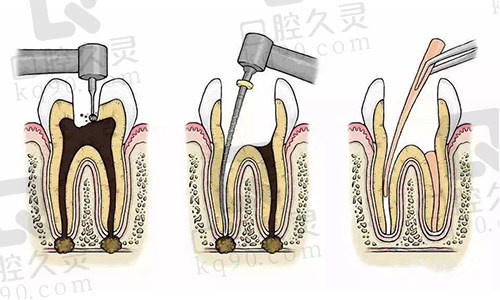 根管治疗