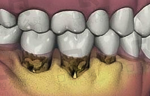 牙周炎疾病导致牙根外露