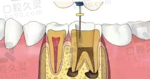 根管治疗