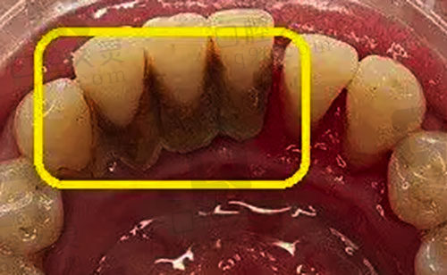 牙结石堆积示范图