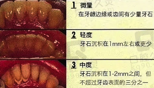 牙结石不同程度等级