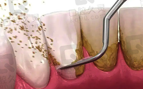 洗牙处理牙齿结石问题