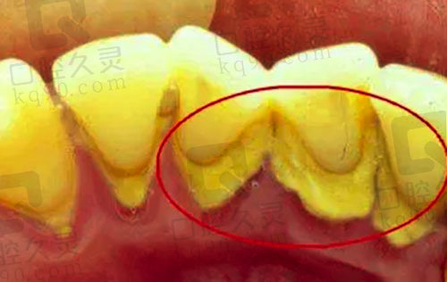 牙齿结石堆积引发牙齿疾病