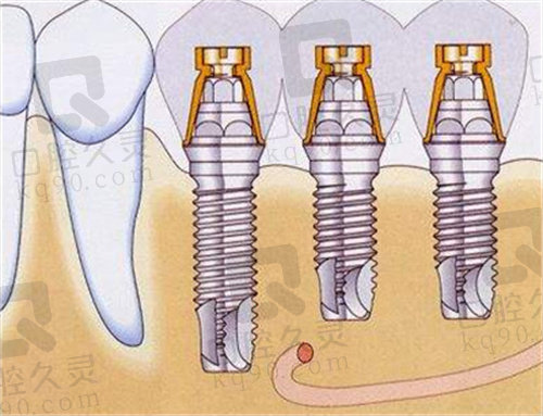 德国贝格种植体的特点及优势2