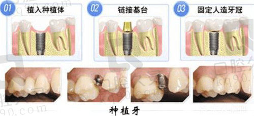 呼和浩特欧贝口腔种植牙步骤