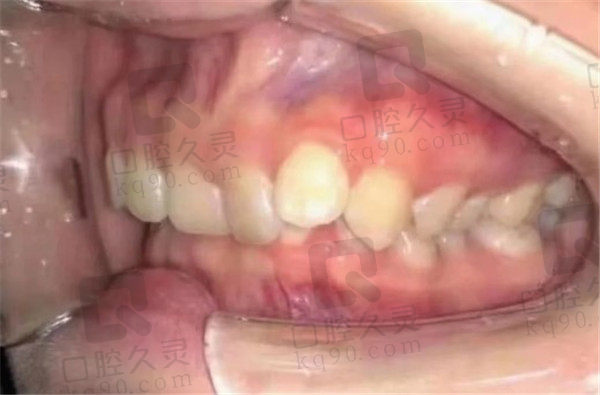 成都极光口腔矫正前牙齿状态