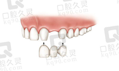 种植牙修复