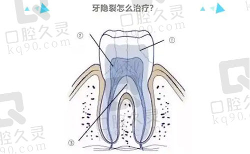 牙隐裂怎么治疗？