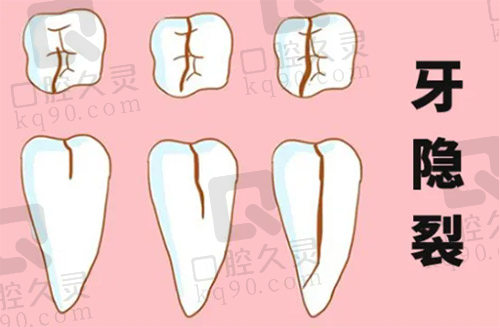 牙隐裂的发展过程