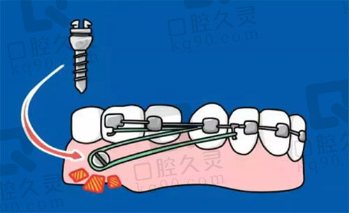 正畸支抗钉