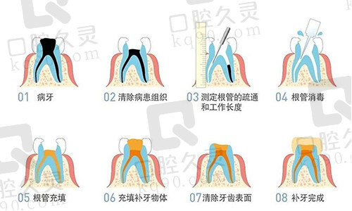 根管治疗步骤图