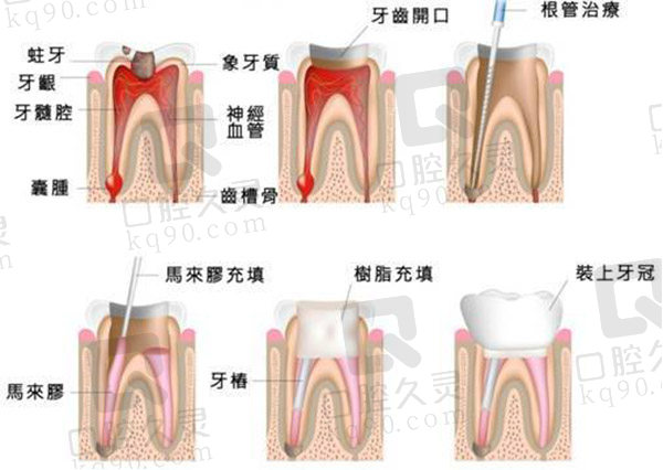 根管治疗