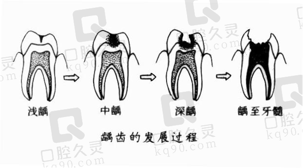 龋齿