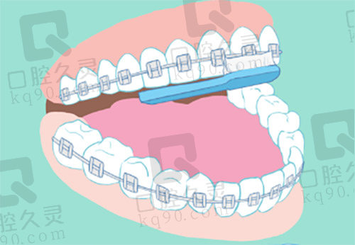 正畸刷牙