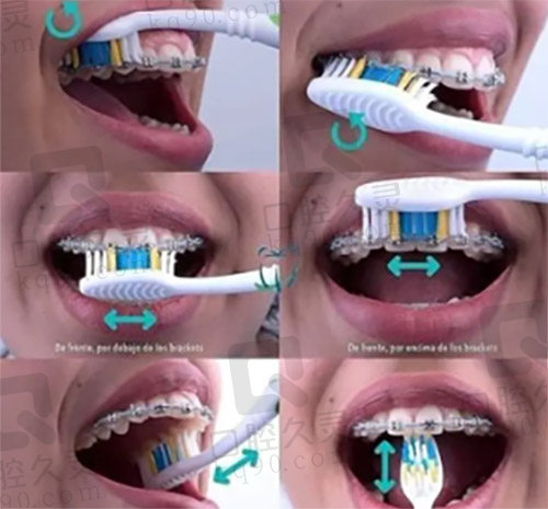 正畸时如何正确刷牙