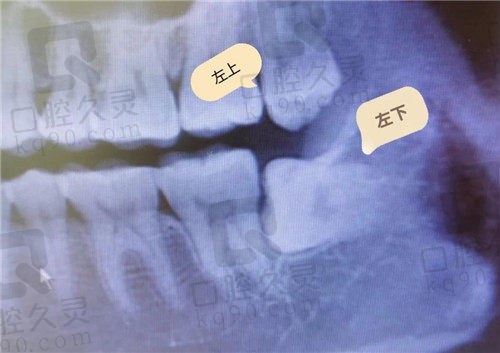 济宁口腔医院拔牙CT照2