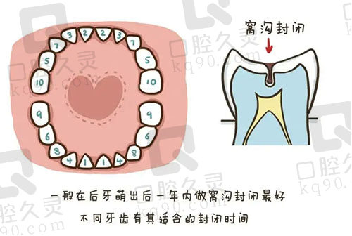 窝沟封闭的时间