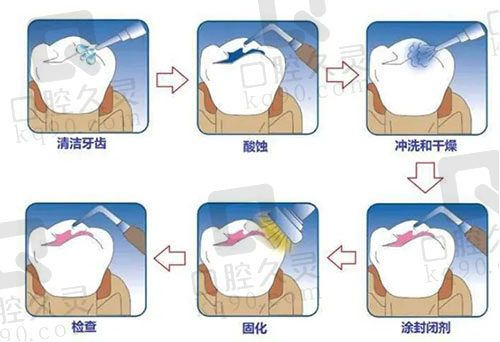 窝沟封闭的流程