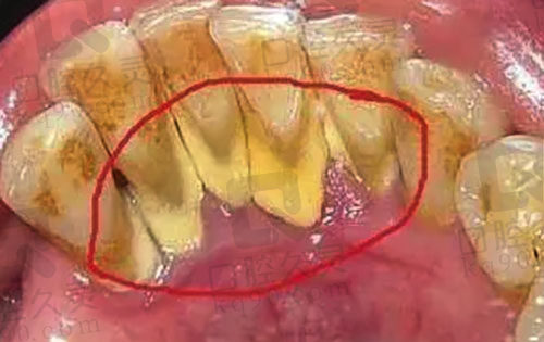 牙齿结石过多
