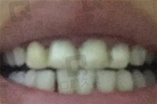 杭州一牙口腔全瓷冠修复临时牙佩戴