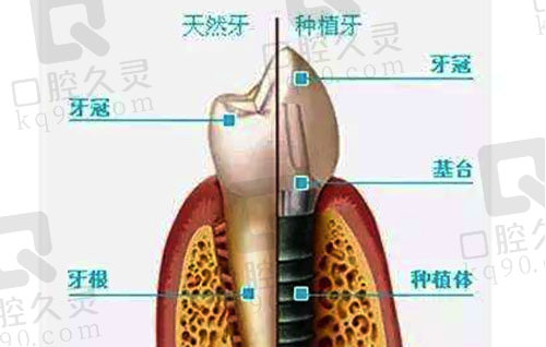 自然牙和种植牙间的区别