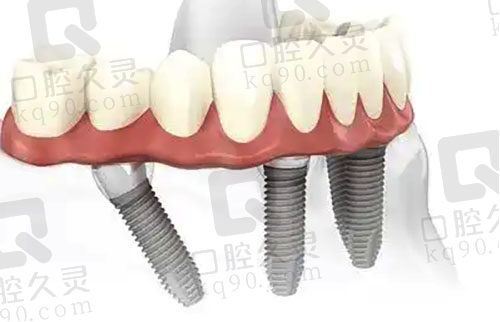 all-on-4种植牙技术