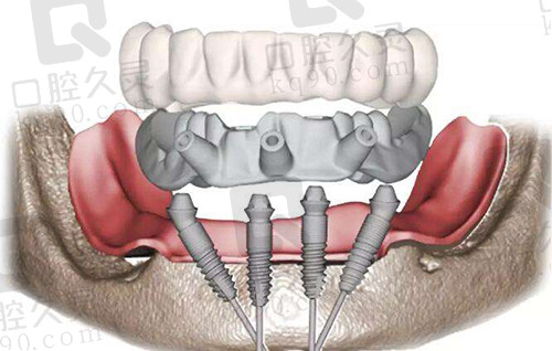 all-on-4即刻负重种植技术