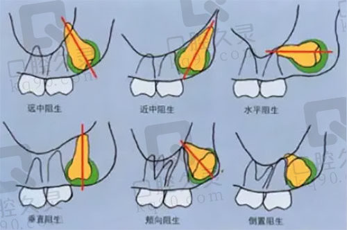 智齒一半長在肉裡不疼要拔嗎?