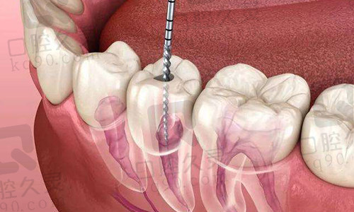 根管治疗过程