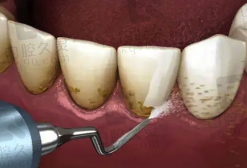通过洁牙清除牙齿表面结石