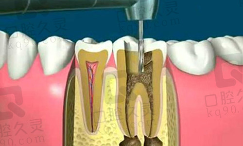 根管治疗