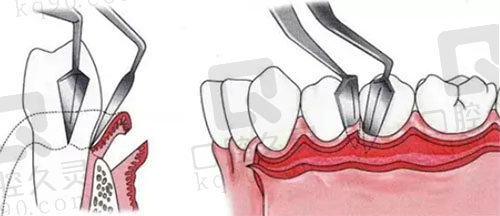 牙周刮治