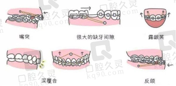 北京芽美口腔牙齿矫正可解决的缺陷